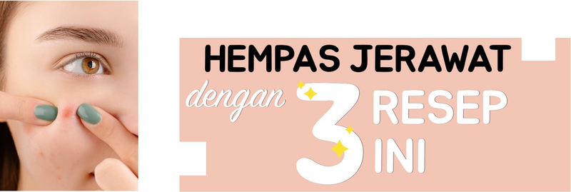 Highlight image for [FREE] 3 cara atasi jerawat dengan bahan alami